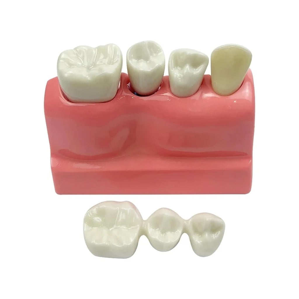Dental Implant Model with Removable Crown Bridge Dental Veneers Porcelain Teeth for Stutent Study and Teaching Demonstration