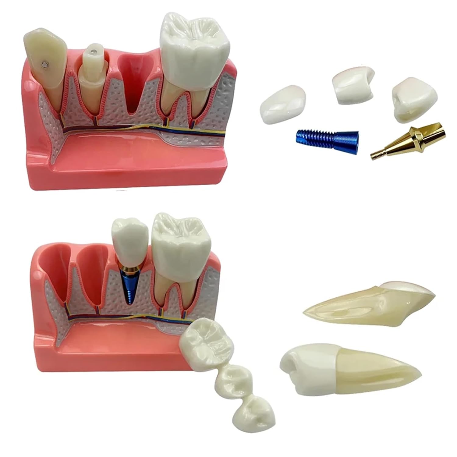 Dental Implant Model with Removable Crown Bridge Dental Veneers Porcelain Teeth for Stutent Study and Teaching Demonstration