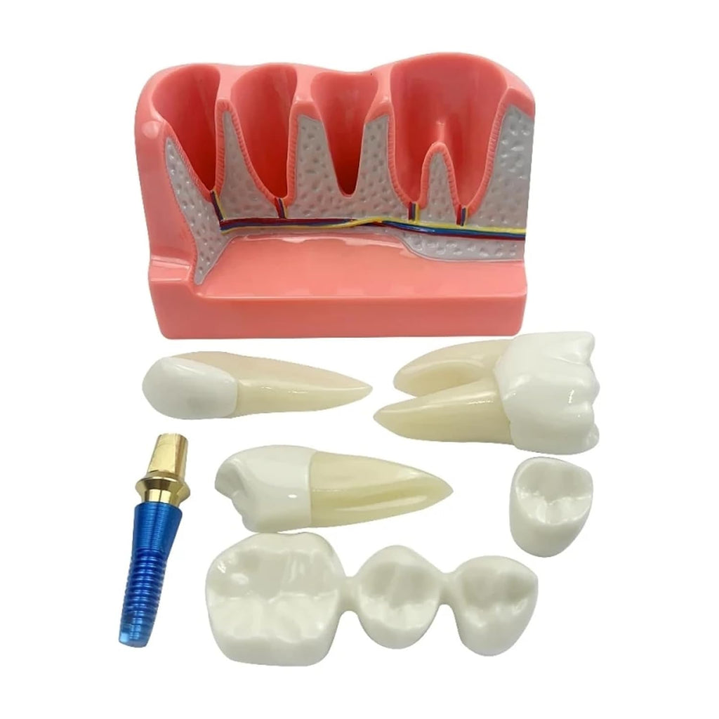Dental Implant Model with Removable Crown Bridge Dental Veneers Porcelain Teeth for Stutent Study and Teaching Demonstration