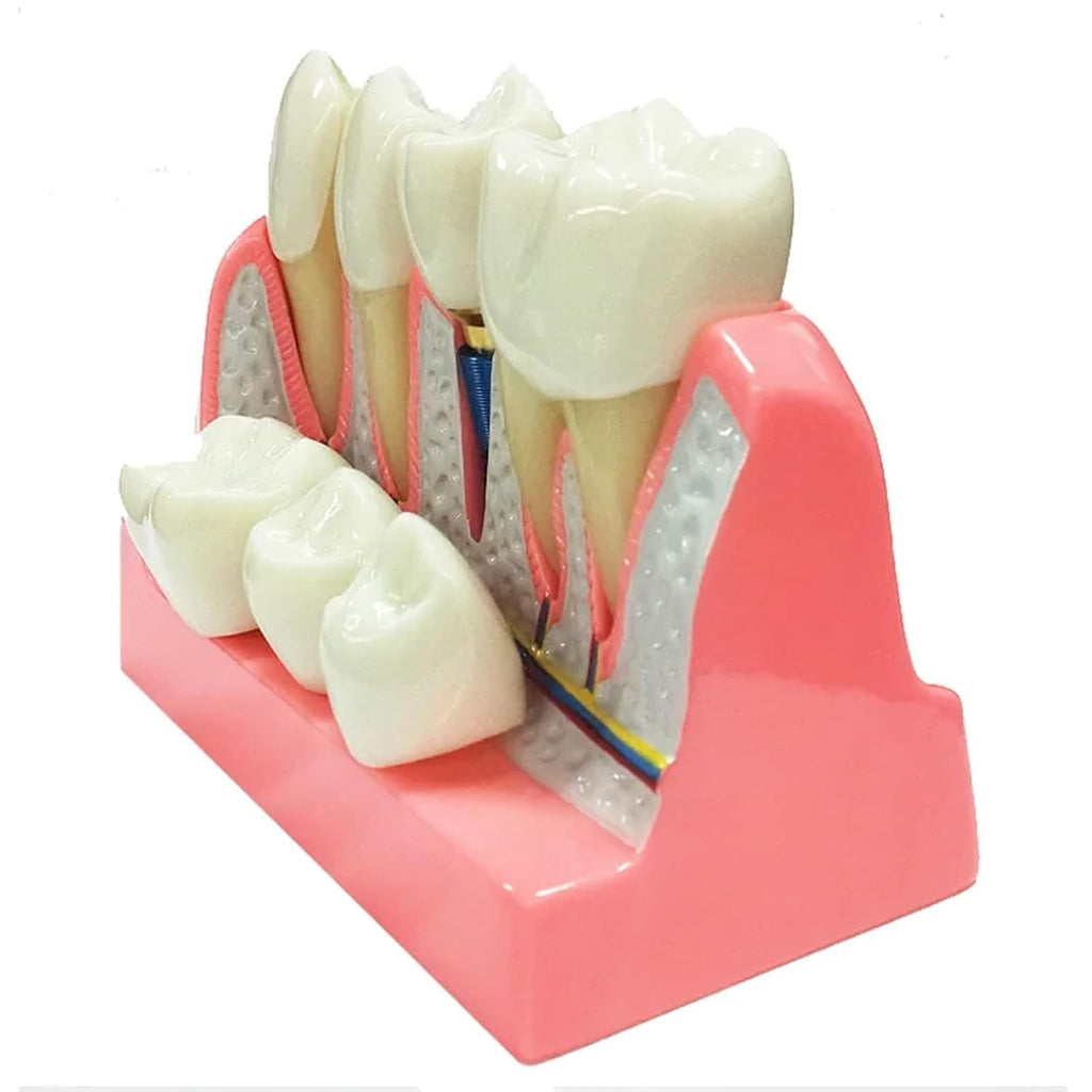 Dental Implant Model with Removable Crown Bridge Dental Veneers Porcelain Teeth for Stutent Study and Teaching Demonstration