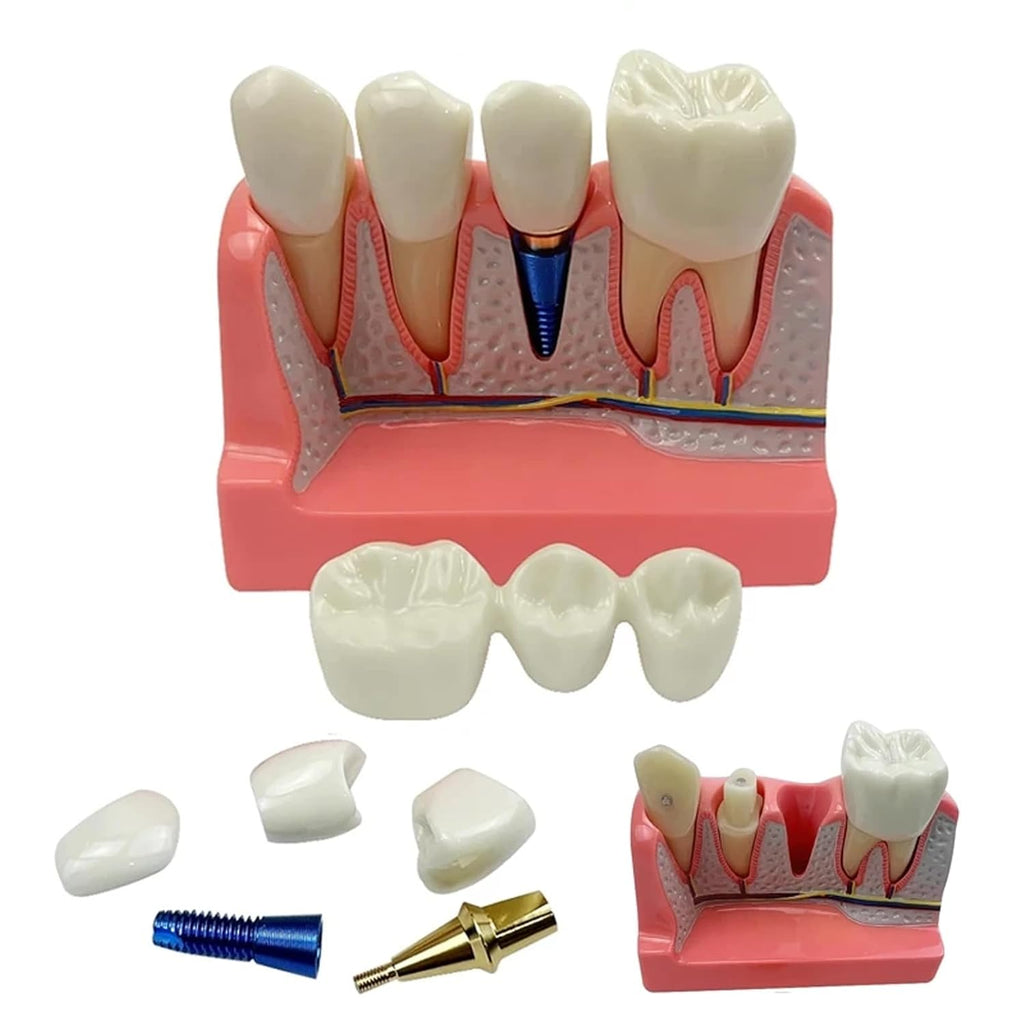 Dental Implant Model with Removable Crown Bridge Dental Veneers Porcelain Teeth for Stutent Study and Teaching Demonstration