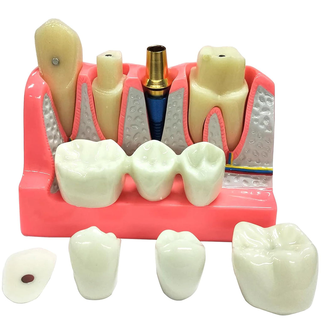 Dental Implant Model with Removable Crown Bridge Dental Veneers Porcelain Teeth for Stutent Study and Teaching Demonstration