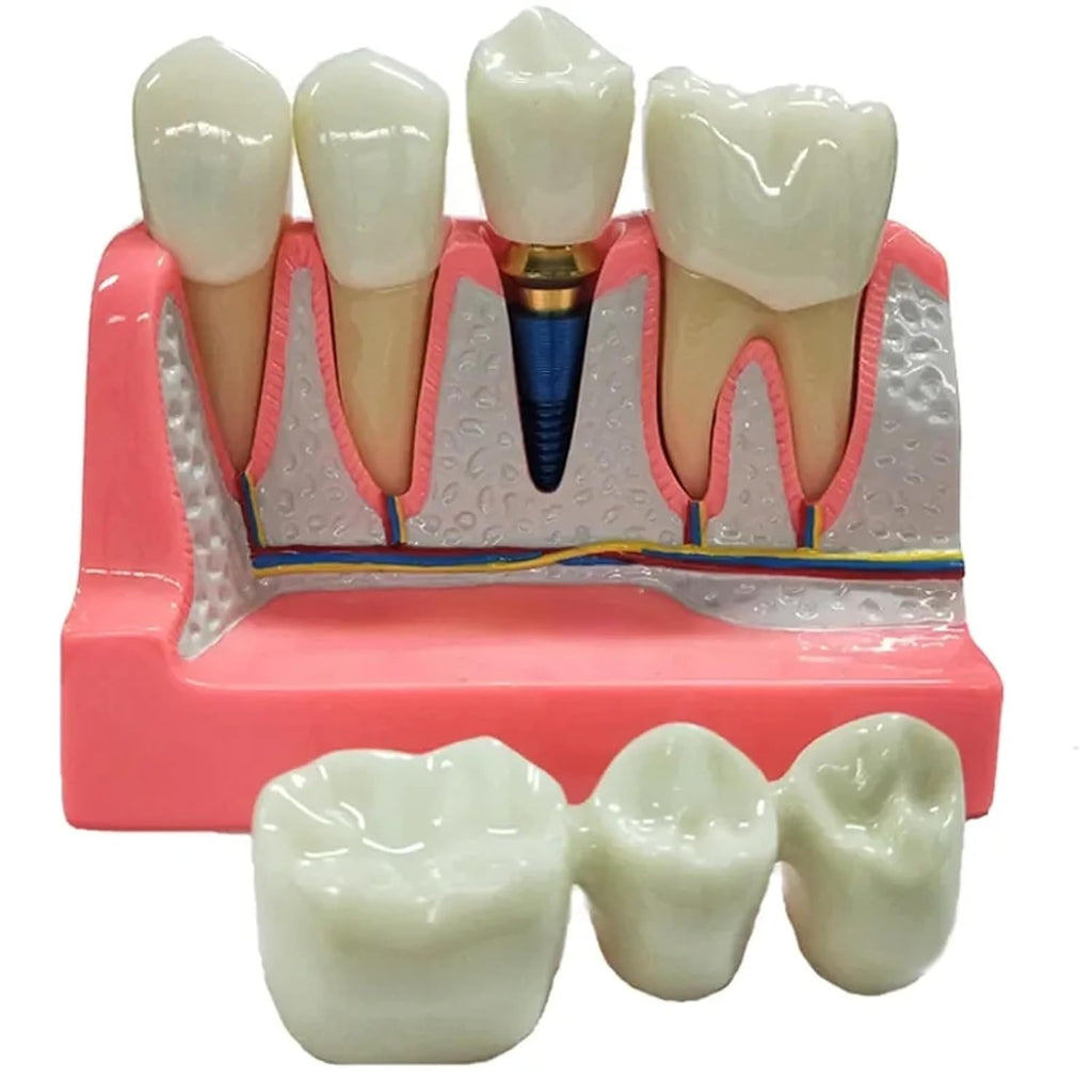 Dental Implant Model with Removable Crown Bridge Dental Veneers Porcelain Teeth for Stutent Study and Teaching Demonstration